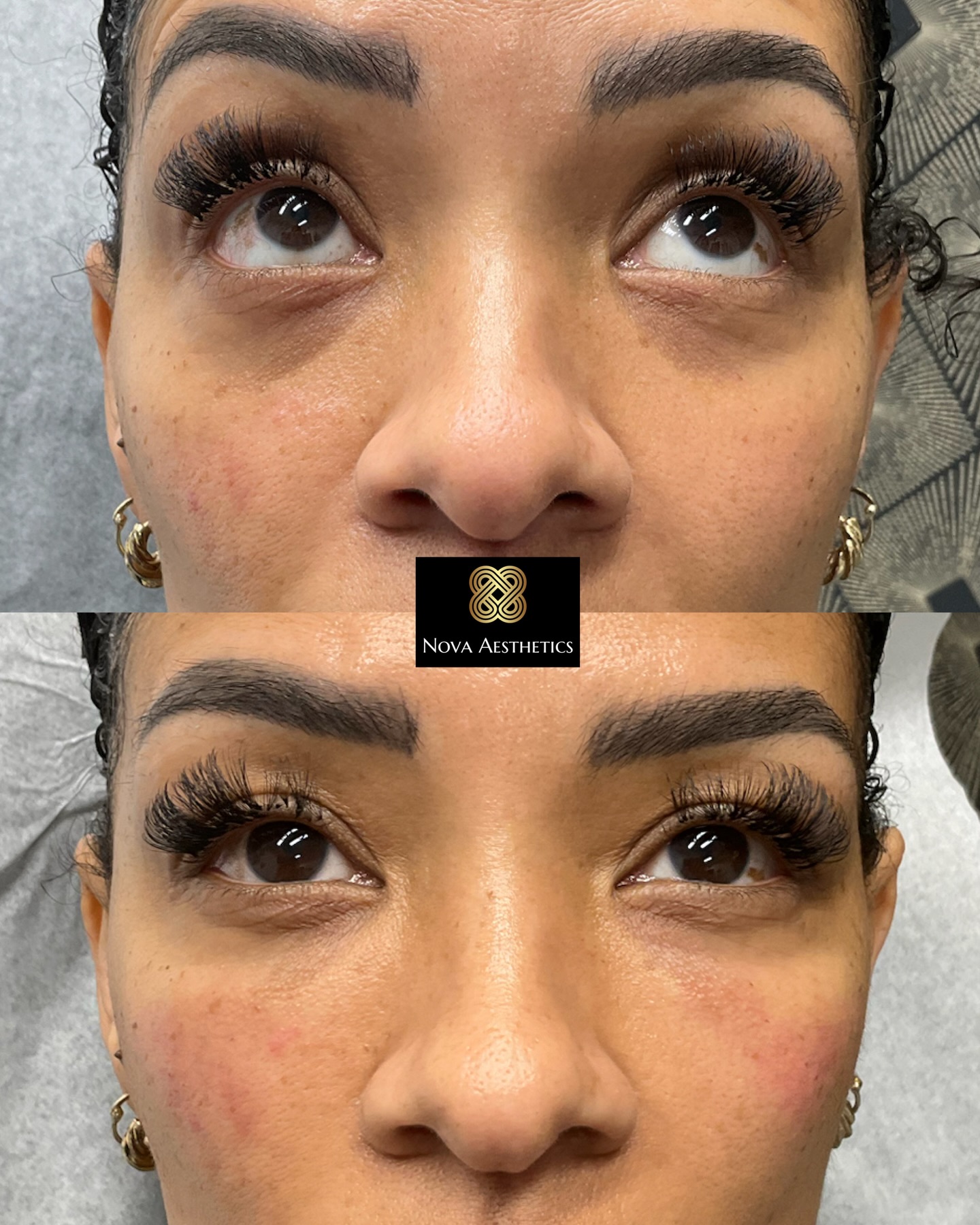 Ezgel before and after
