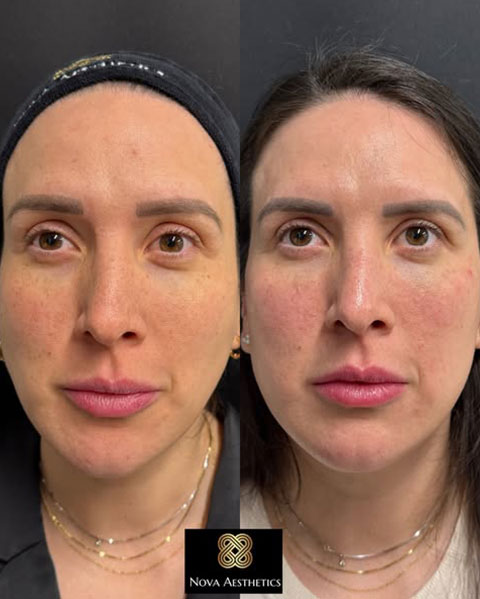 Halo laser before and after