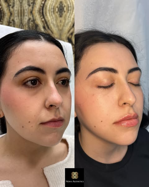 Lip filler before and after