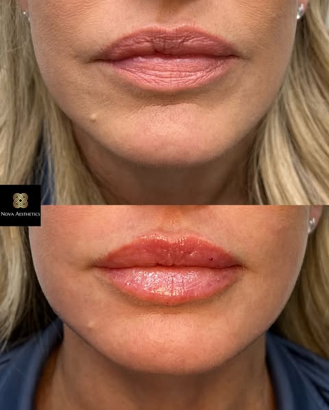 Lip filler result before and after