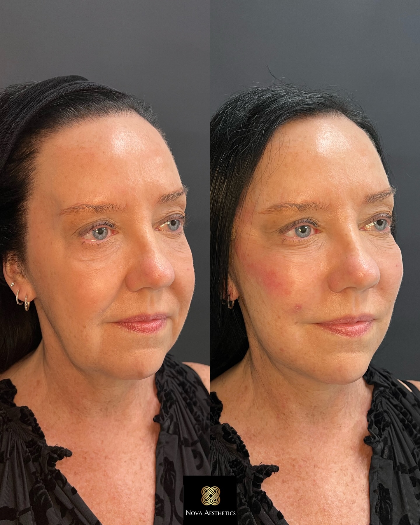 PDO Thread Lift before and after